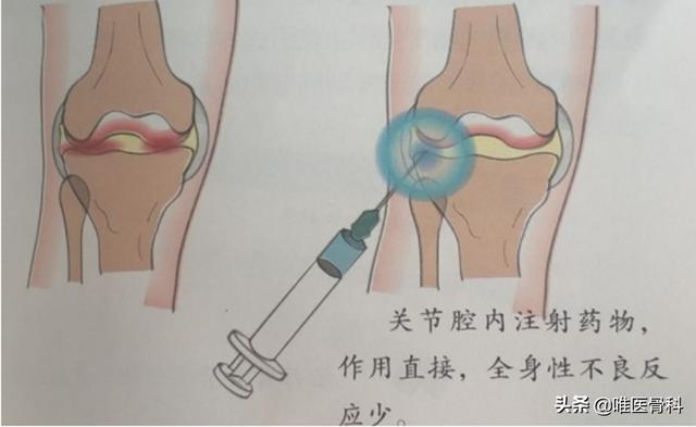 關節炎，用哪些藥？骨科醫生：這 4 種藥，了解一下（關節炎首選藥）