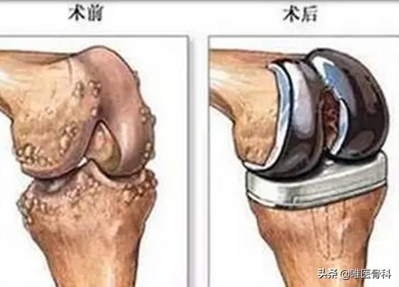 關節炎，用哪些藥？骨科醫生：這 4 種藥，了解一下（關節炎首選藥）