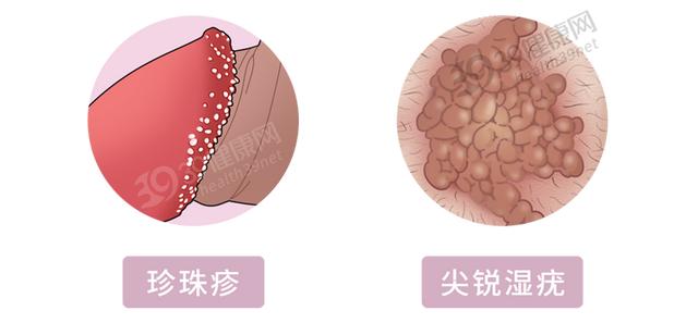 丁丁長了“珍珠疹”，怎么辦？哪些藥物能治好？建議男人都看看