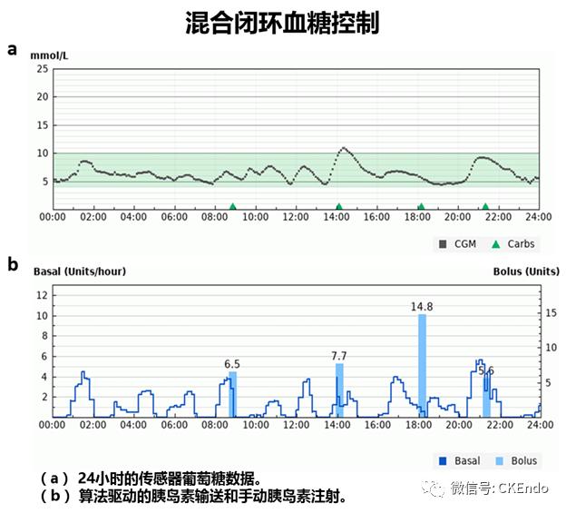 臨床內(nèi)分泌未來篇 - 2021新閉環(huán)胰島素系統(tǒng)-傳感器、胰島素泵和控制系統(tǒng)