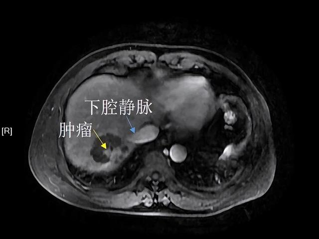 要的就是精準！手術無法切除腫瘤，這項“黑科技”為他帶來希望......